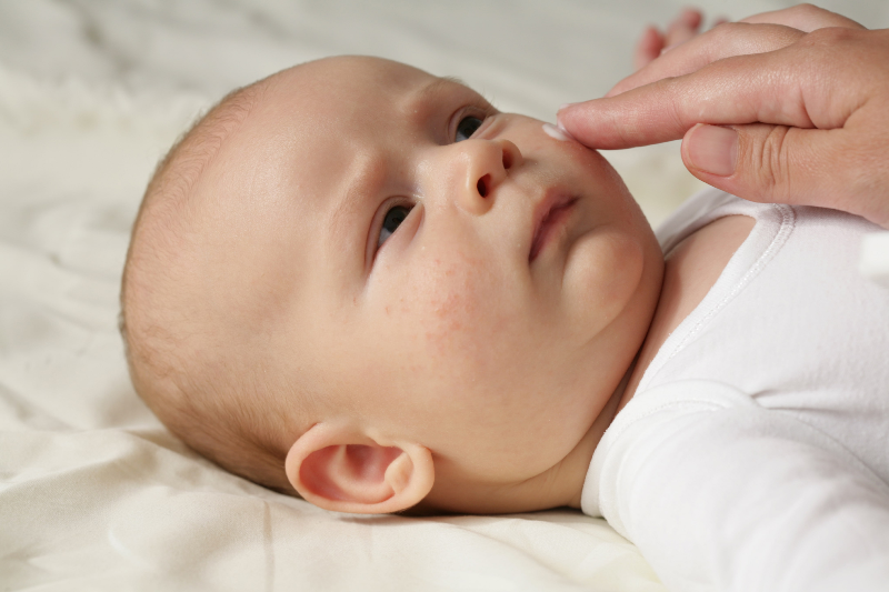 علل جوش های سفید زیر پوستی نوزادان