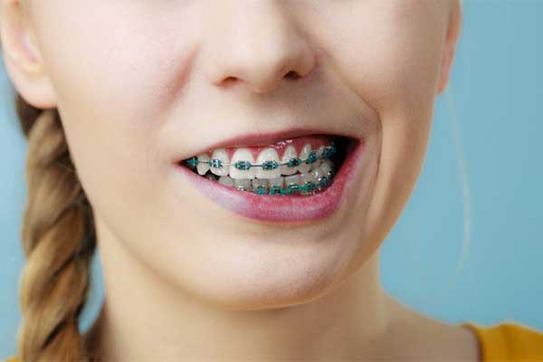 بهترین زمان ارتودنسی چه سنی است؟