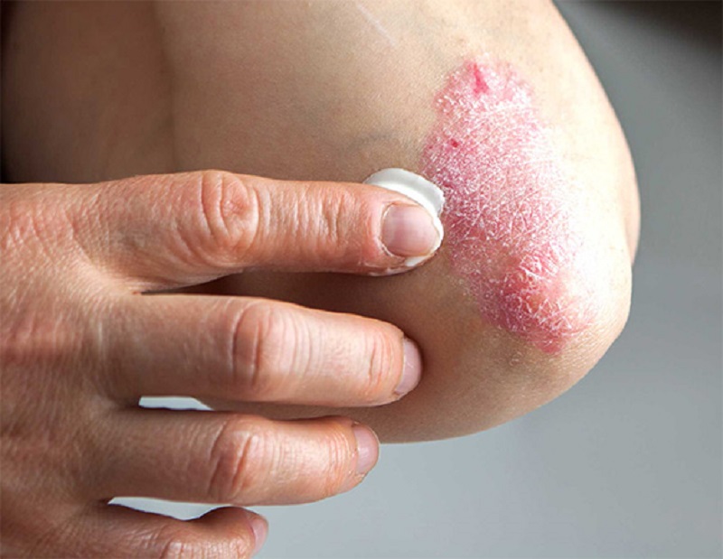  درمان اگزمای پوستی با یک روش غیرمعمول