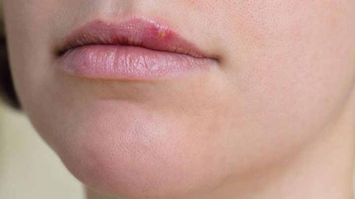 روشی فوری برای خداحافظی با تبخال