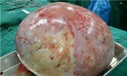 خارج کردن توده ۴/۵ کیلویی از یک شکم یک زن! +عکس