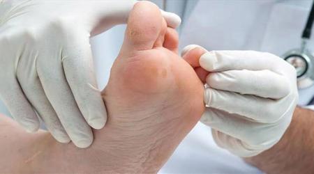 راهنمای بالینی درمان زخم پای دیابتی تدوین شد