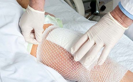  1.5میلیون نفر زخم پای دیابتی دارند