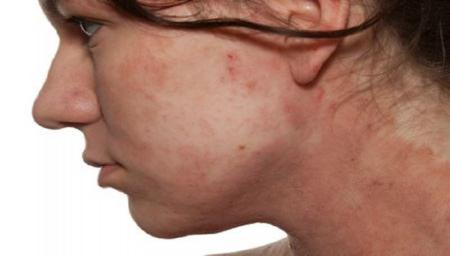 عوارض استرس و اضطراب بر سلامت پوست چیست
