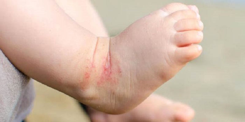 اگزما را به راحتی با این روغن درمان کنید