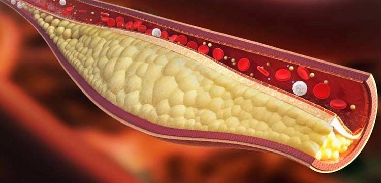 چربی خون در بدن چه علائمی دارد
