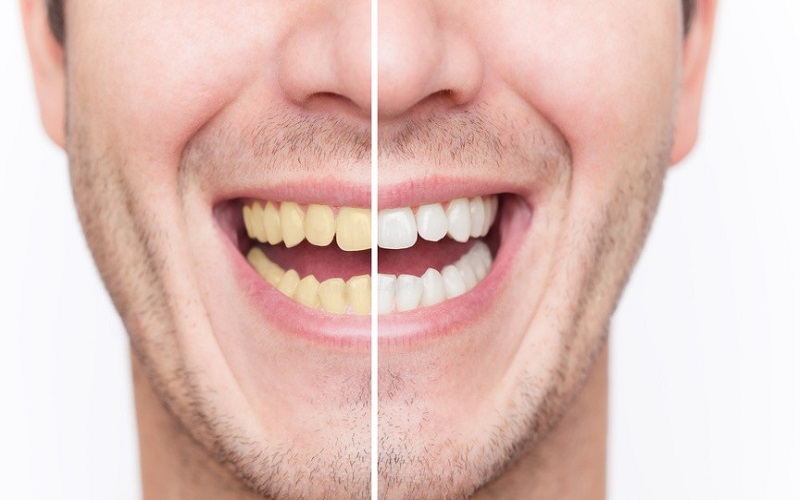 دلیل اصلی زرد شدن رنگ دندان چیست؟
