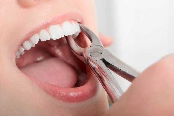  دندان عقل همیشه کشیدنی است؟