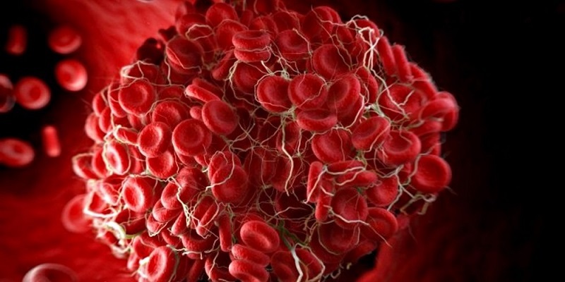 علائمی که نشان می‌دهند لخته خون در بدن دارید