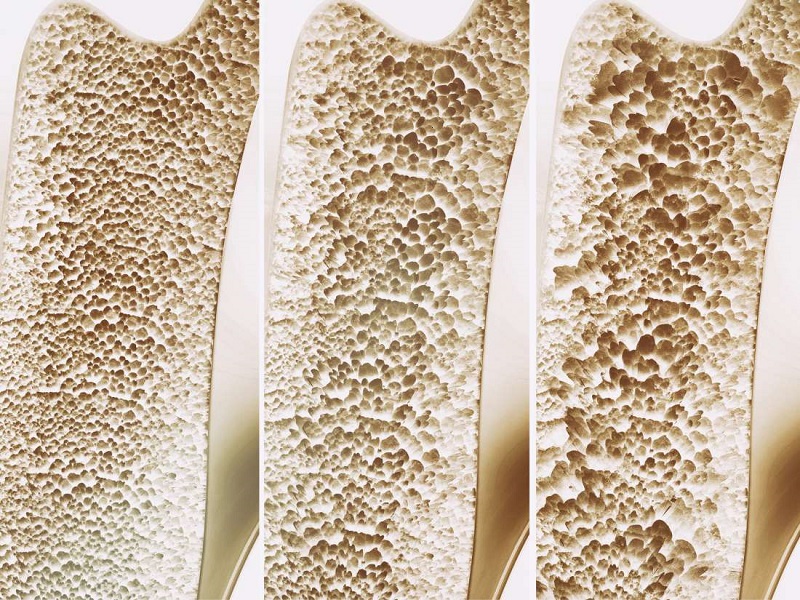 باکتری های پروبیوتیک از پوکی استخوان پیشگیری می کنند