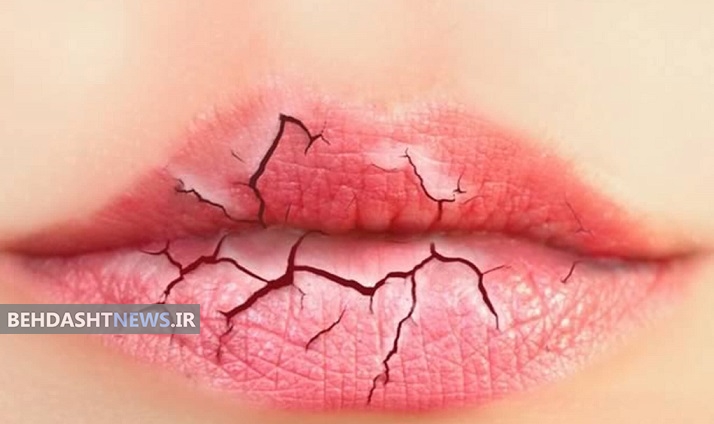 چرا لب‌ها پوسته پوسته می شود؟