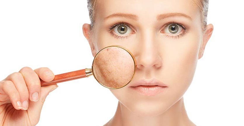 چگونه می توان در 2 شب لک های قهوه ای پوست را از بین برد ؟