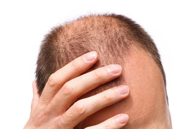 دارویی  برای  رشد دوباره مو 
