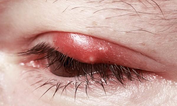 چگونه از شر گل‌مژه خلاص شویم؟