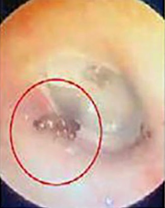 حرکت مورچه‌ در حفره گوش یک مرد + عکس
